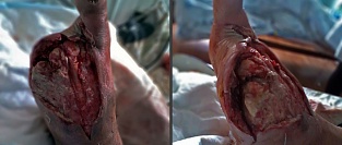 Диабетическая стопа